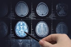 Traumatic Brain Injury Lawyer in Richmond Virginia